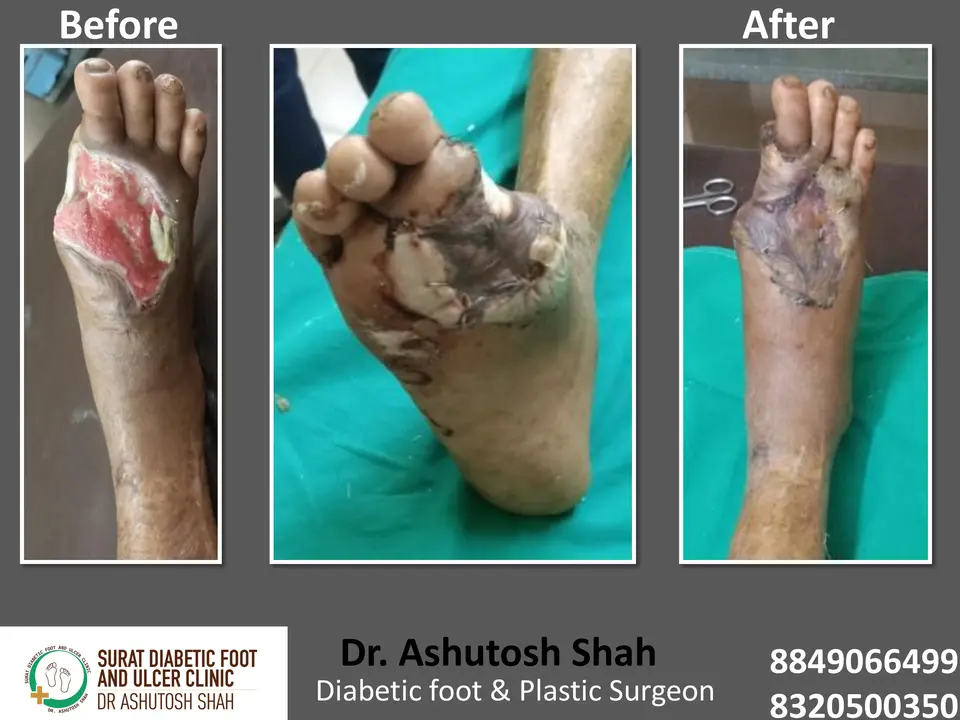 Diabetic Foot  PPT sunita.pptx-41.webp